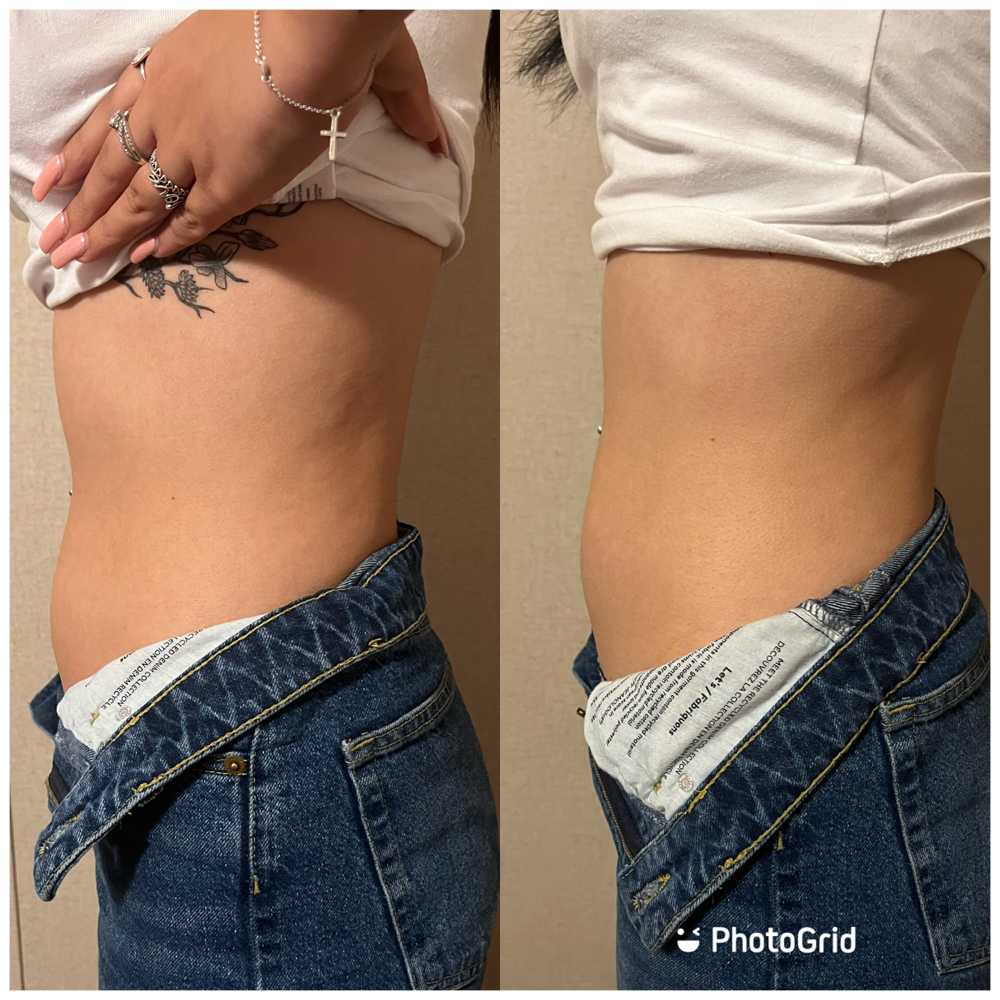 Laser Lipo at BeauTIFFul Modifications in Natalia, TX