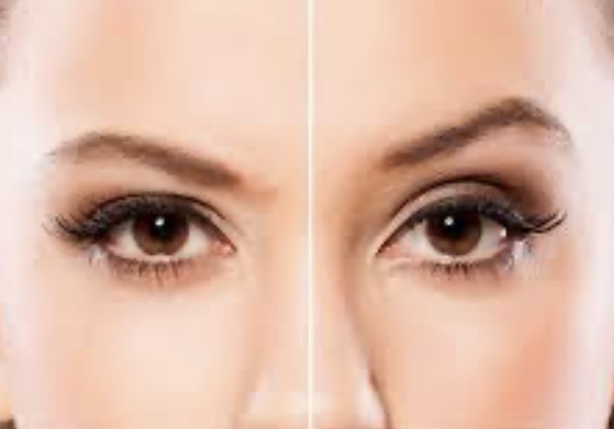 Brow Lift