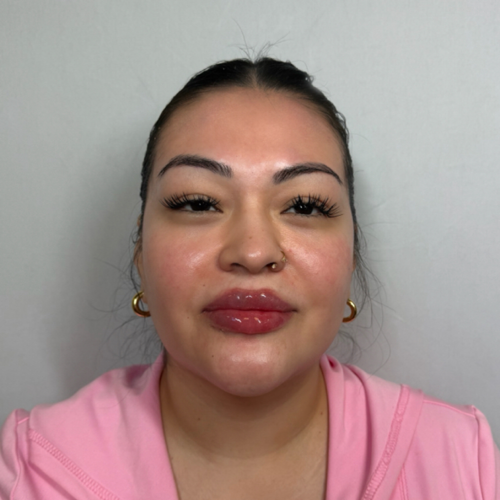 Lip Filler & Antiwrinkle Combo at Eluxy Aesthetics in Arlington, TX