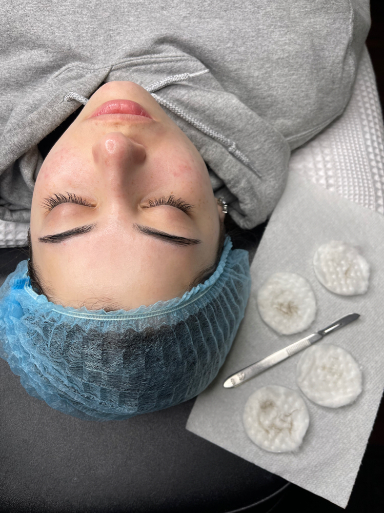 Dermaplaning