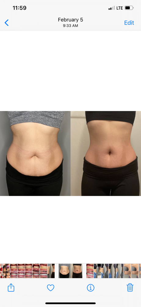 MesoLipo Stomach