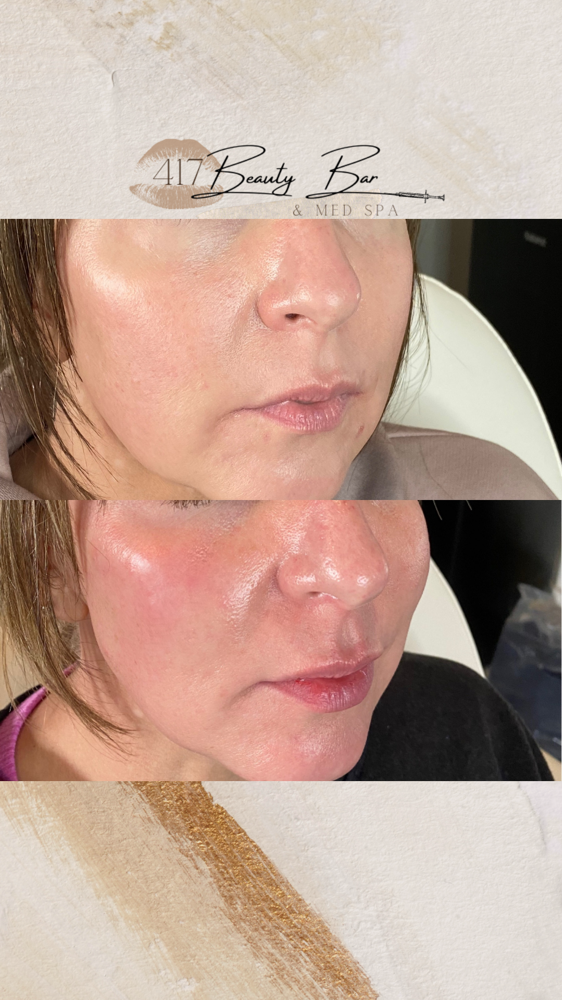 Cheek Filler