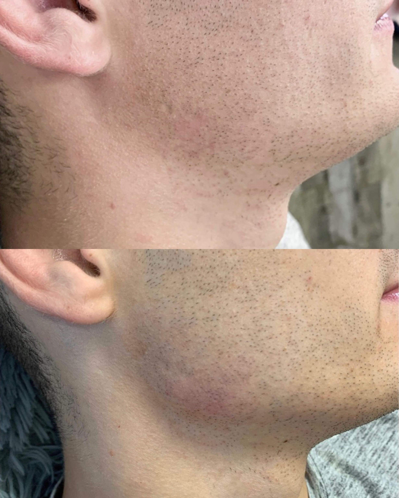 Cheek/Jaw Filler