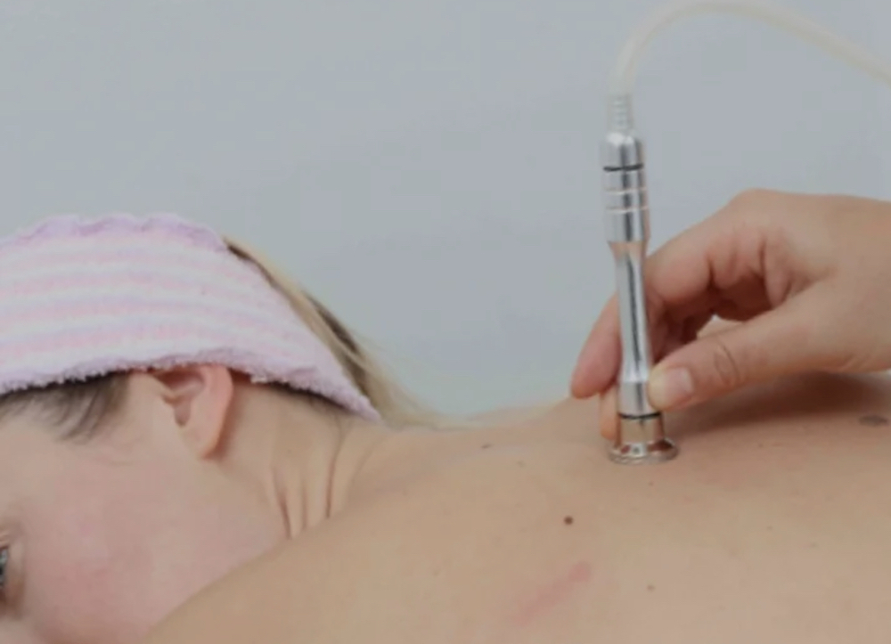 Back Facial With Microdermabrasion