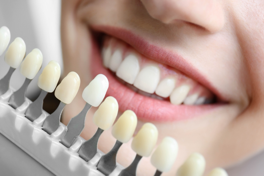 Whitening Consultation