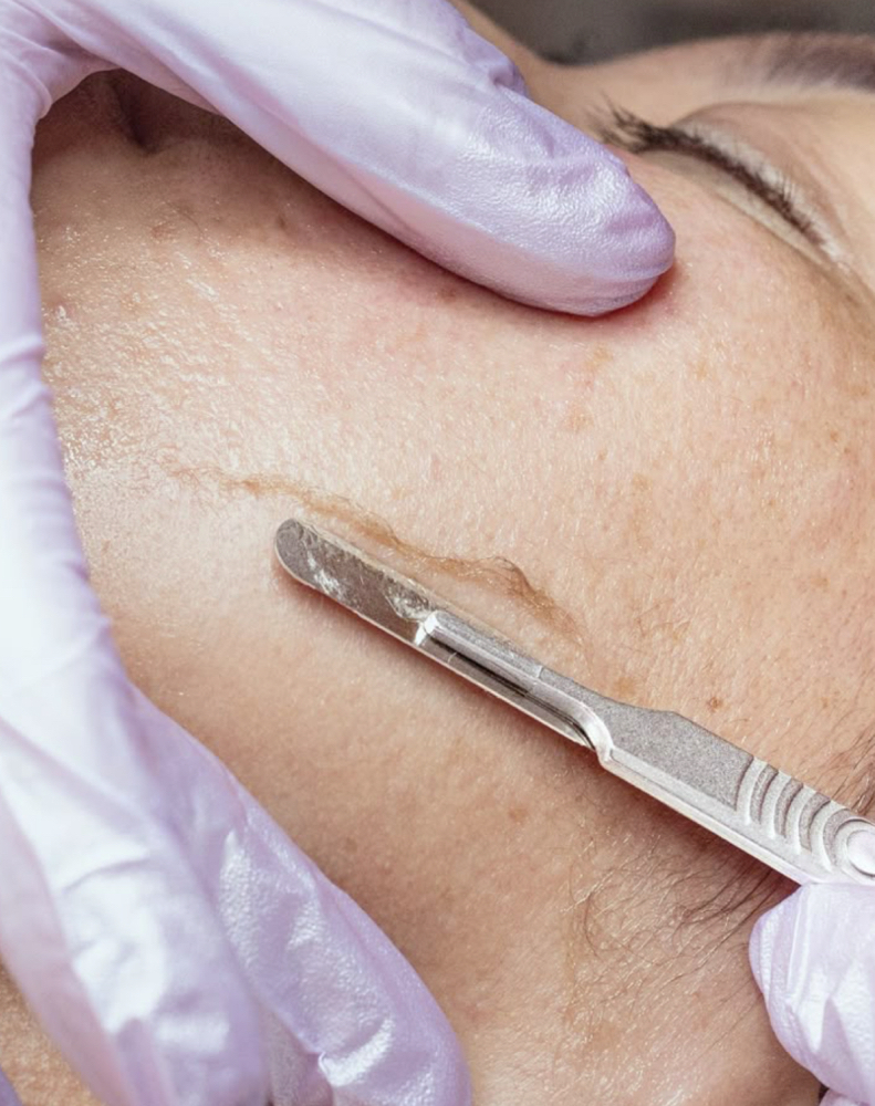 Dermaplane facial