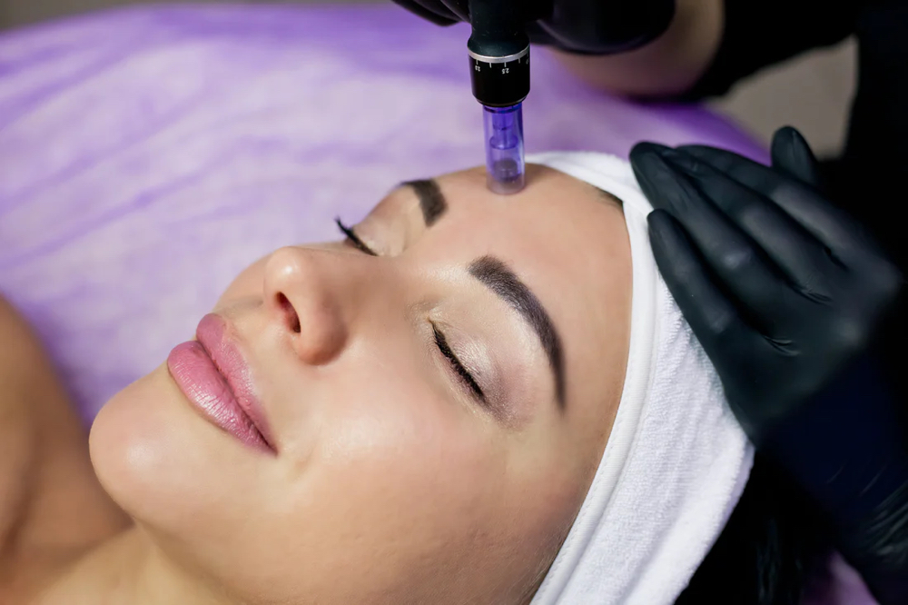 Microneedling with Salmon PDRN at Jewels Beauty in Fairview, NJ