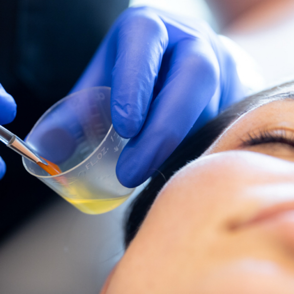 Alpha-Beta Acid Peel at Vanessa Renee Esthetics in Easley, SC