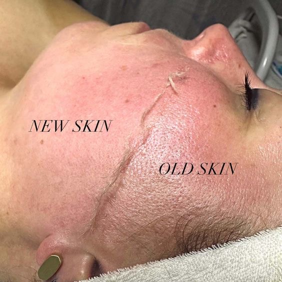 Add-On Dermaplane