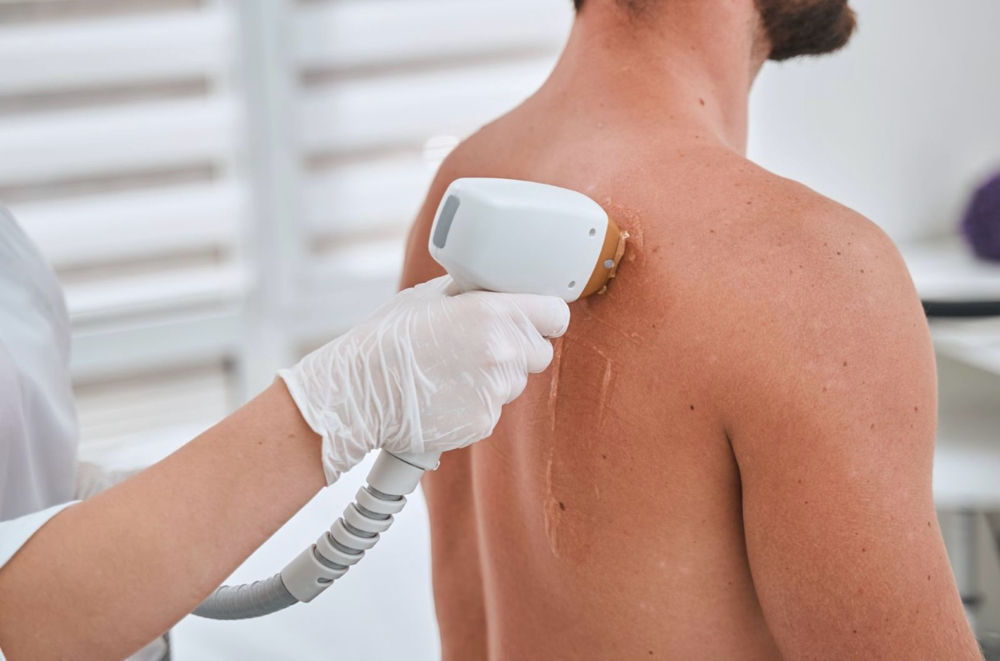 Full Back Laser Hair Removal (singl