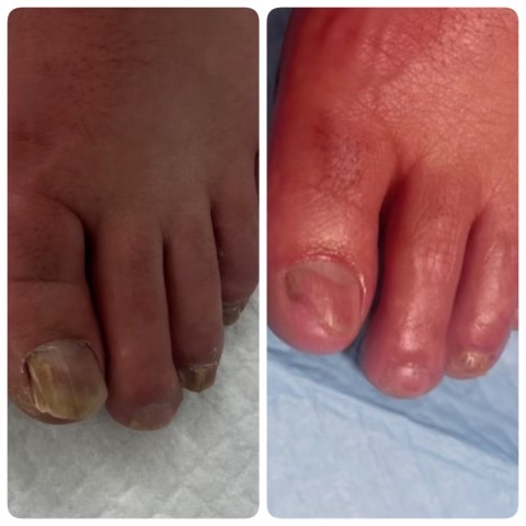 Combined Chiropody Technique