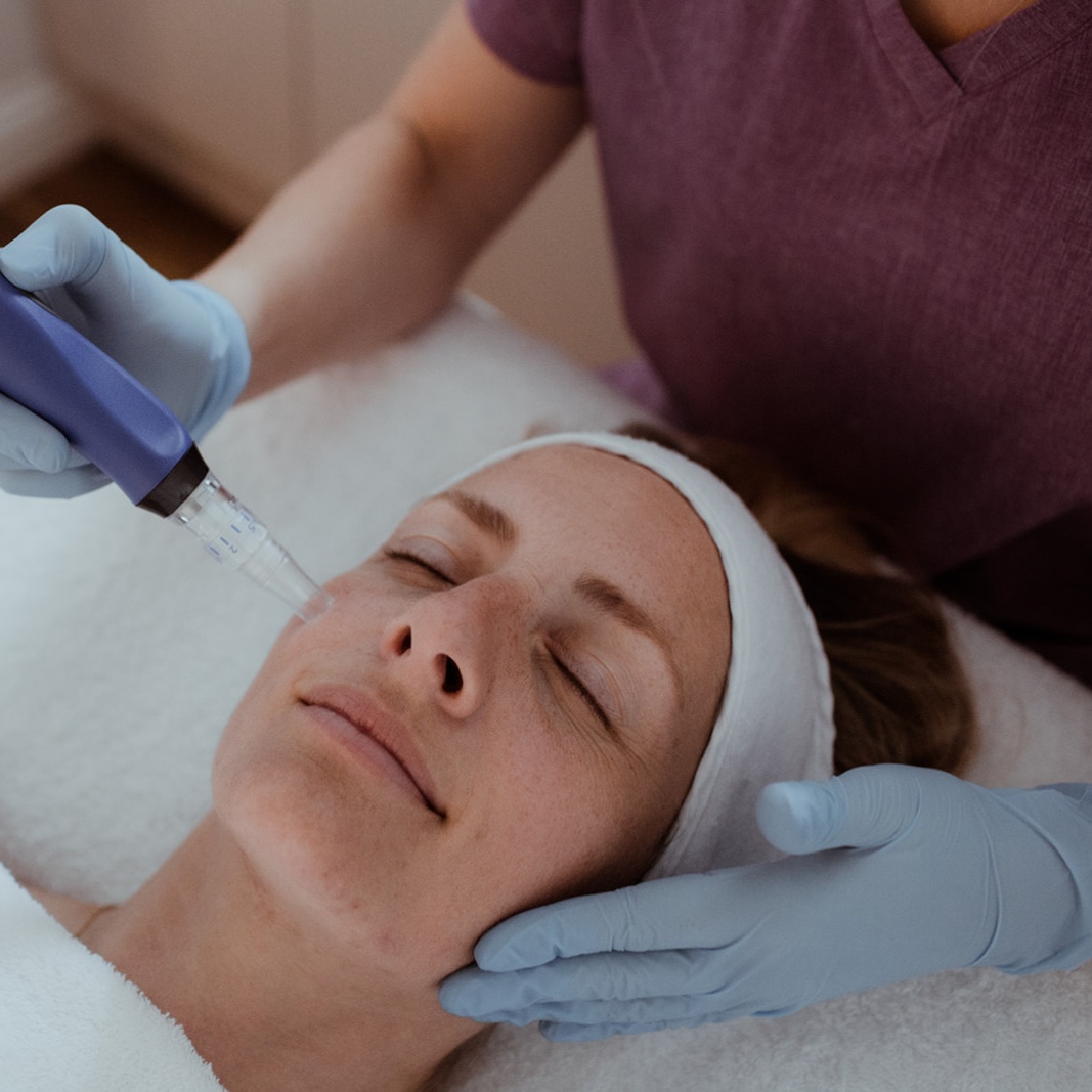 Microchanneling-Microneedling Treat at Milan Salon Spa in El Paso, TX