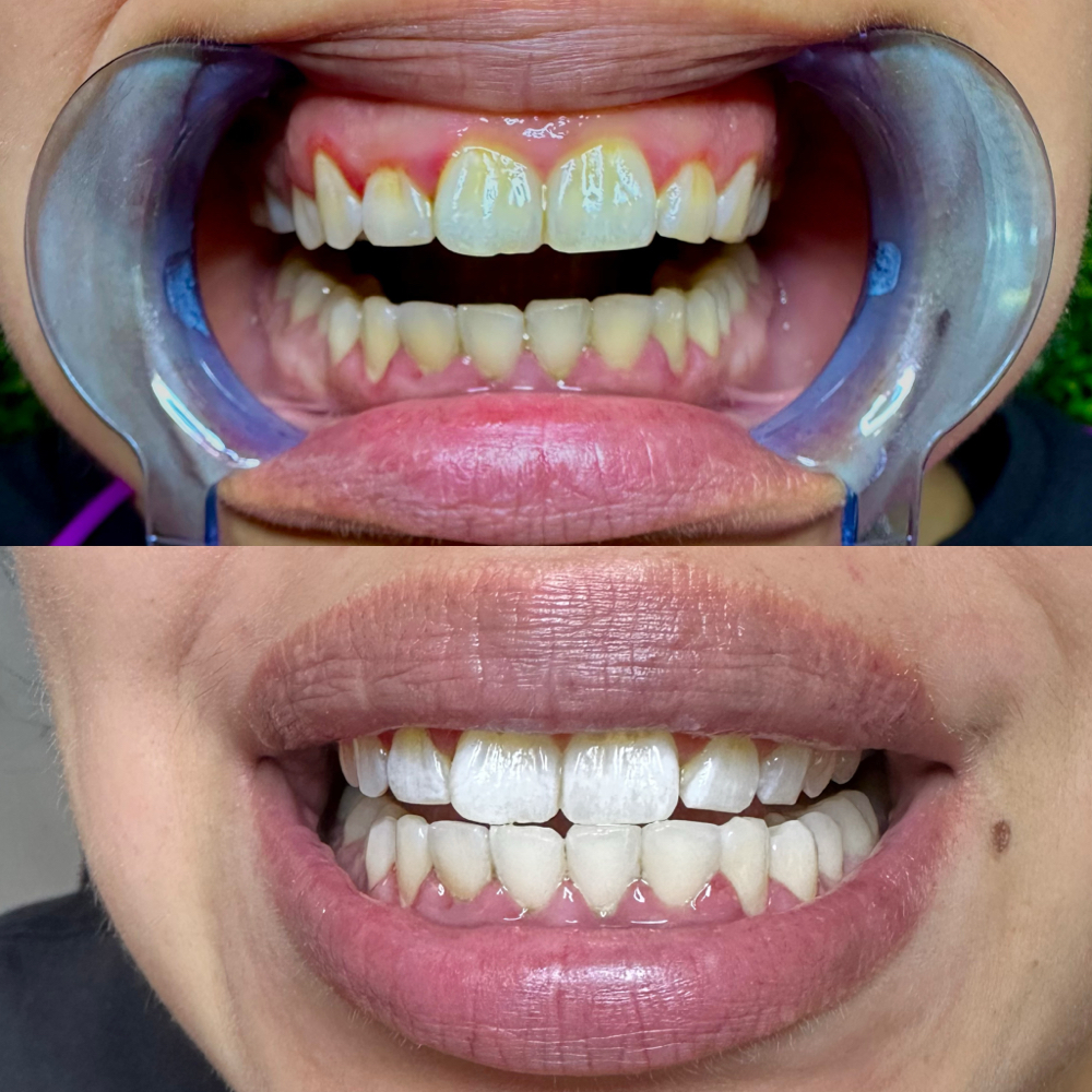 Teeth Whitening🦷