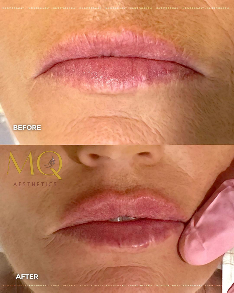 0.5ML Lip Filler
