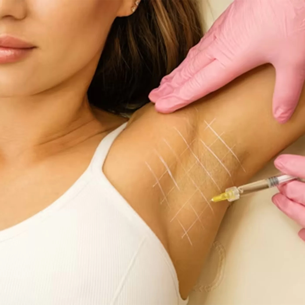 Hyperhidrosis Underarms/Hands at Kelly Sorza Beauty Esthetic in San Jose, CA