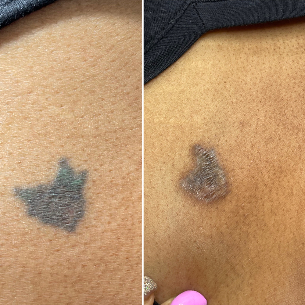 Tattoo Removal - 3rd Session