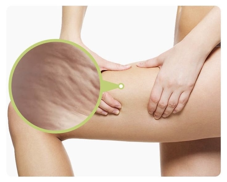 Cellulite Reduction
