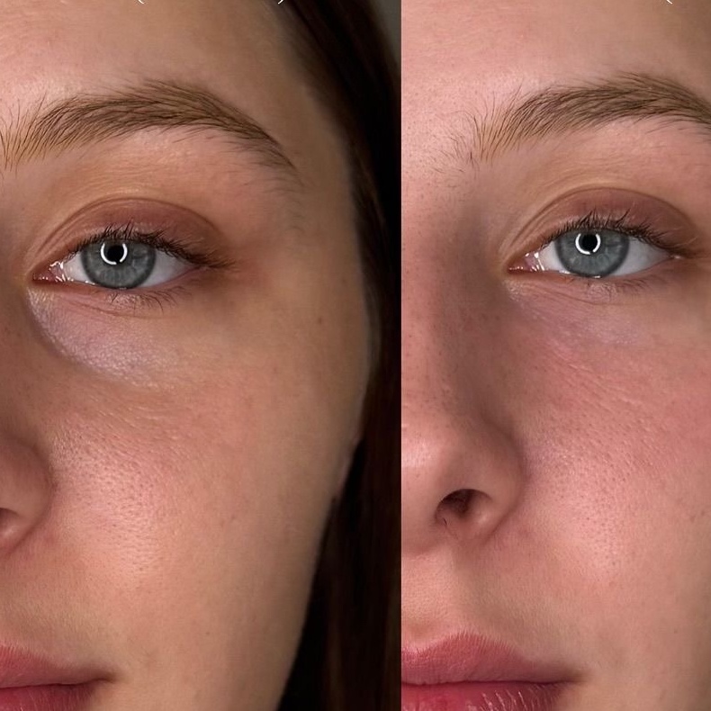 Under-eye filler at Remake Beauty Studio San Juan in San Juan, TX