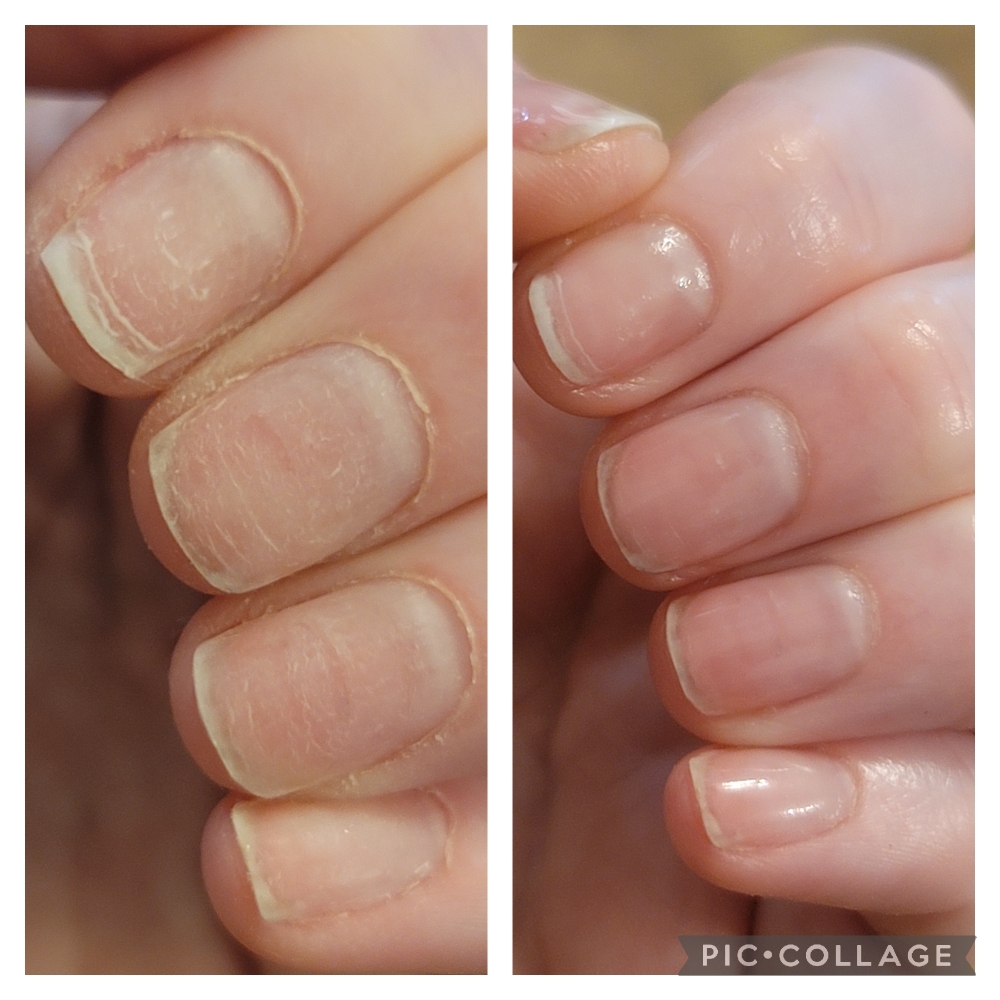 Ongoing IBX Nail Repair Treatment
