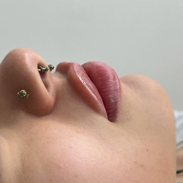 Restylane Filler