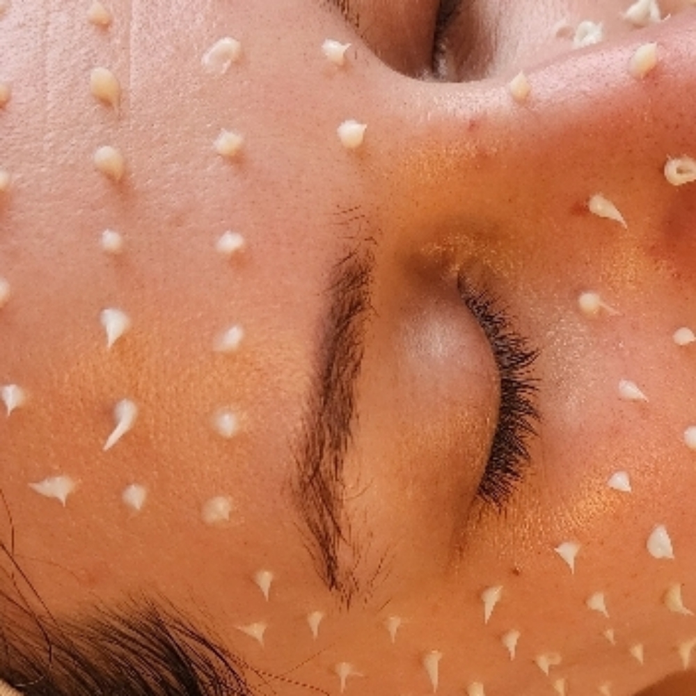 CellStory Liquid Microneedling