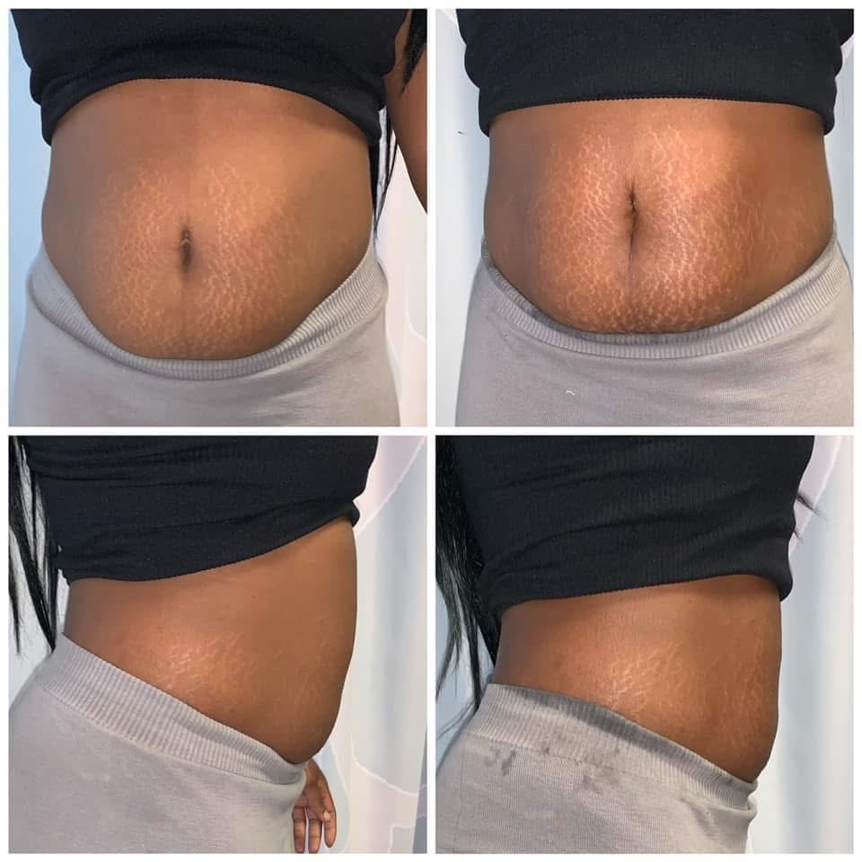 Stomach & Back Cavitation