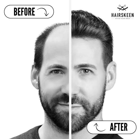 Non Surgical Hair Replacement & Cut