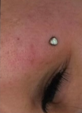 Dermal (large)
