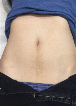 Stomach Strip