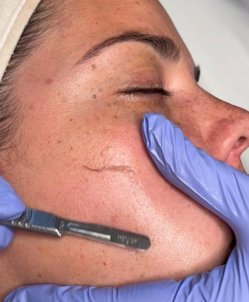 Dermaplaning