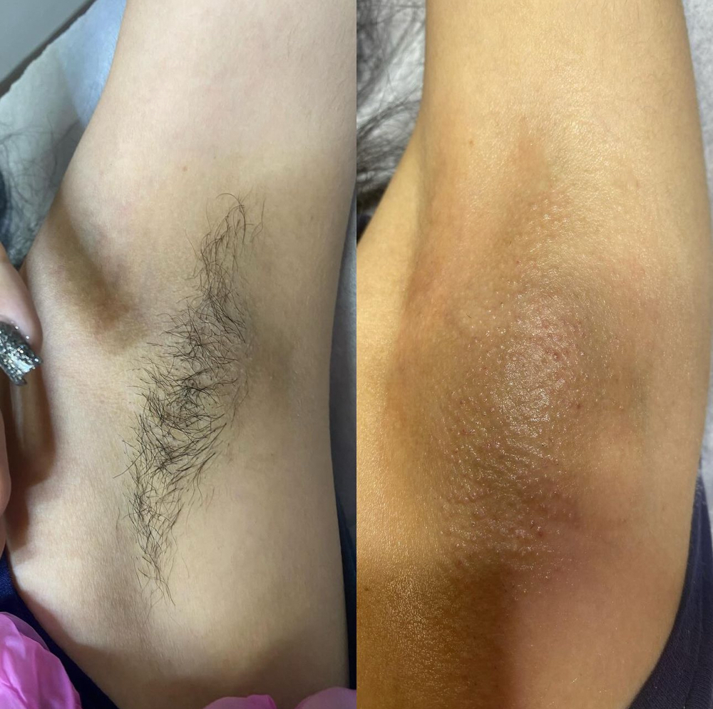 Underarm at Simply Gorgeous Esthetics in Downers Grove, IL