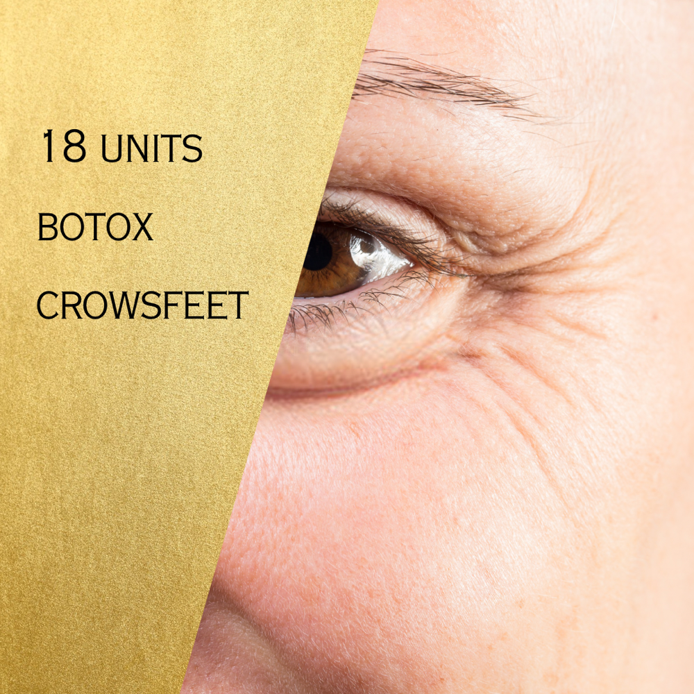 18U Botox Crows Feet