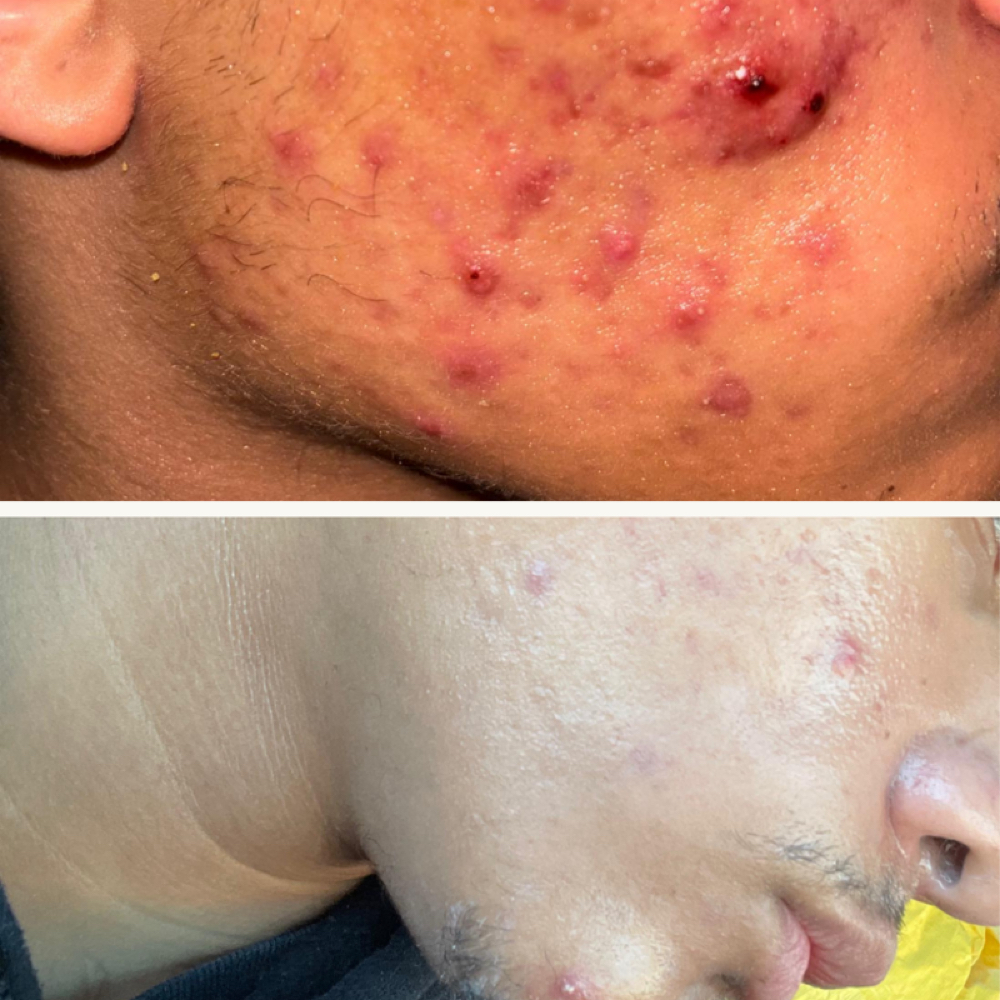 Anti-acne Facial at Nenusk Aesthetics in Long Island City, NY