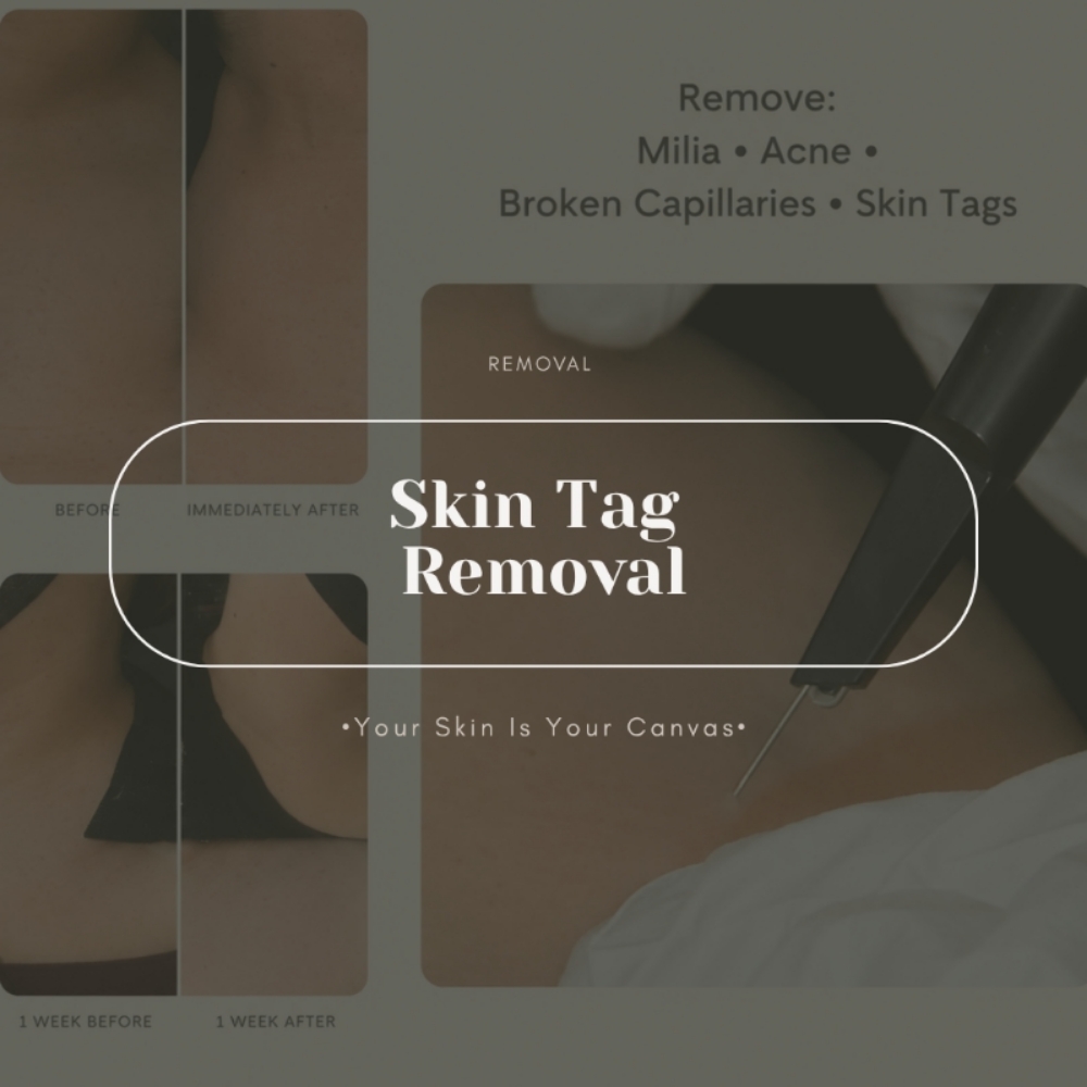 Skin Tag Removal at Face Palette Aesthetics in Franklin, WI