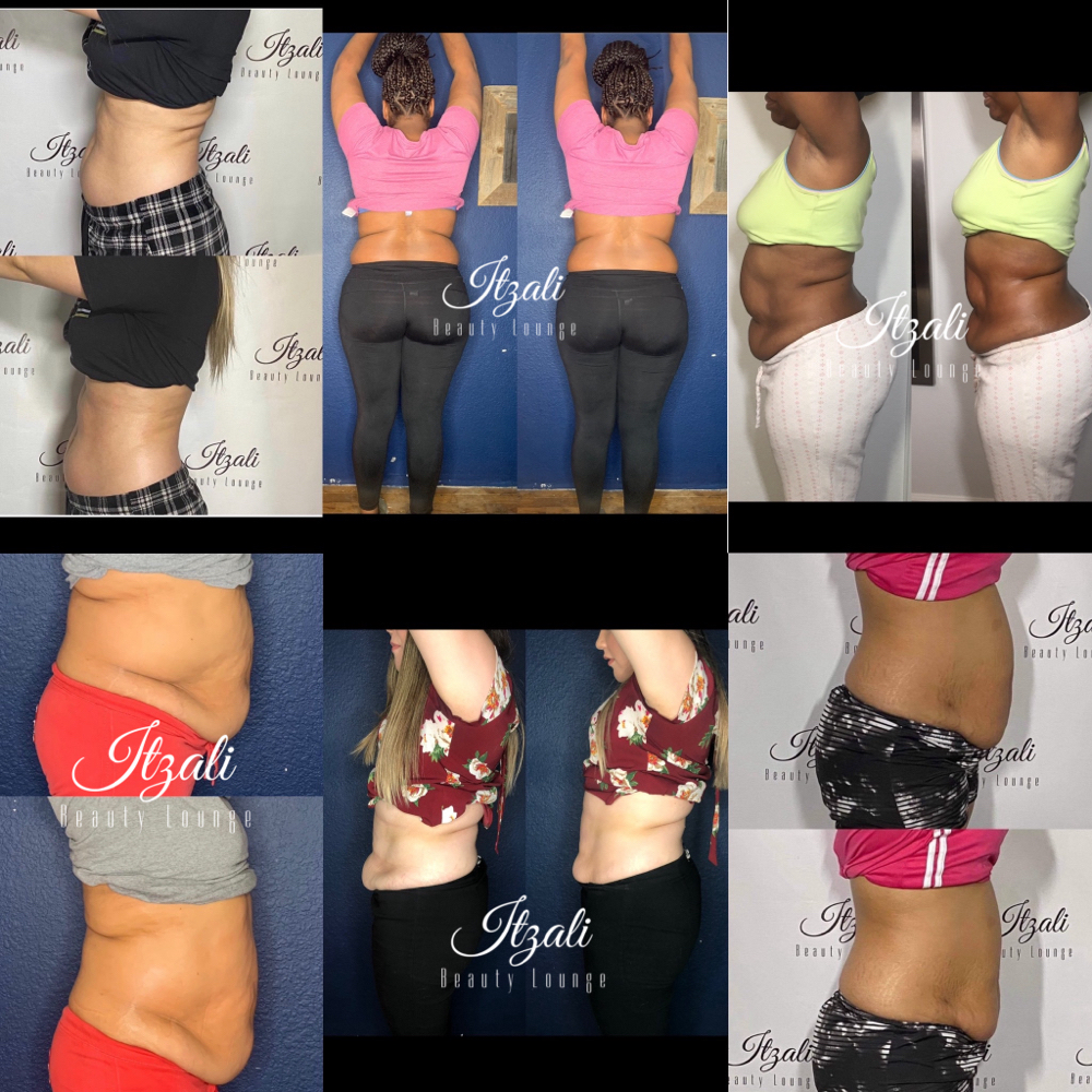 Lipo Cavitation Trial
