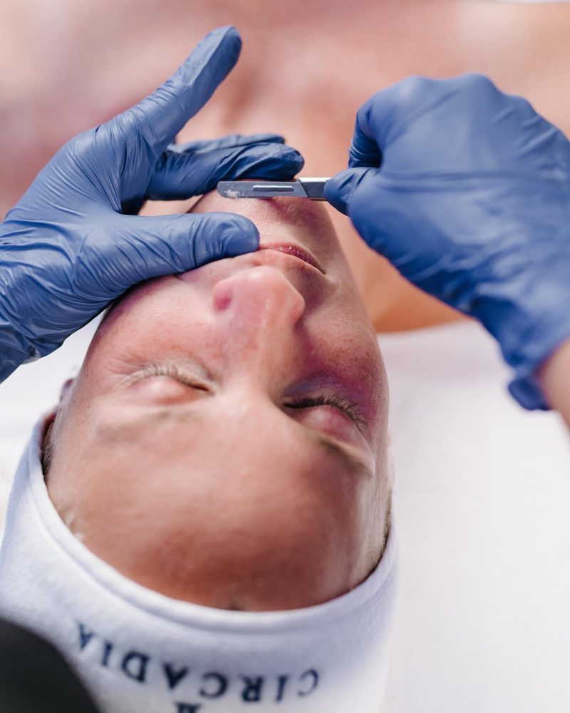 Add On Dermaplane