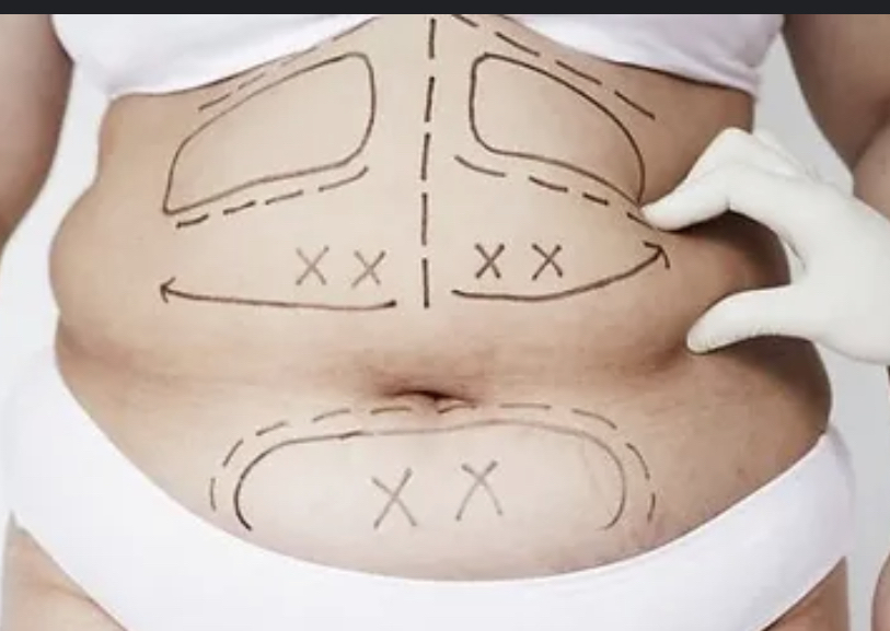(18) Post -op Lymphatic Treatments