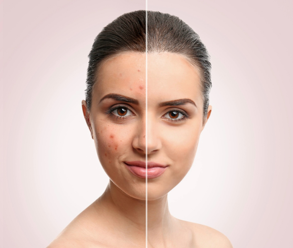 Acne Away Facial