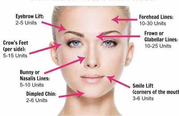 Botox/Dysport/Xeomin