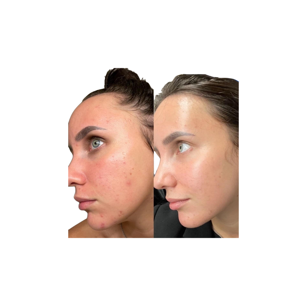 Microneedling