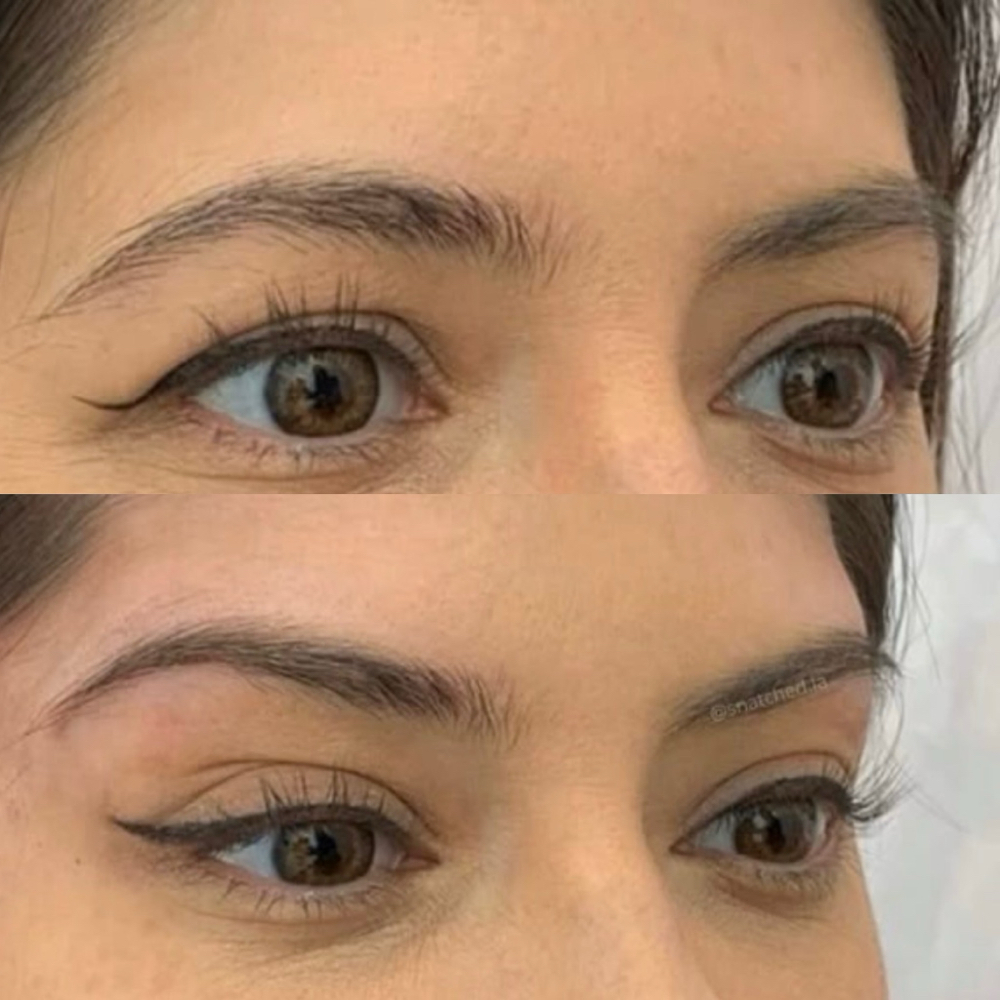 Tox-DAXXIFY Brow Lift