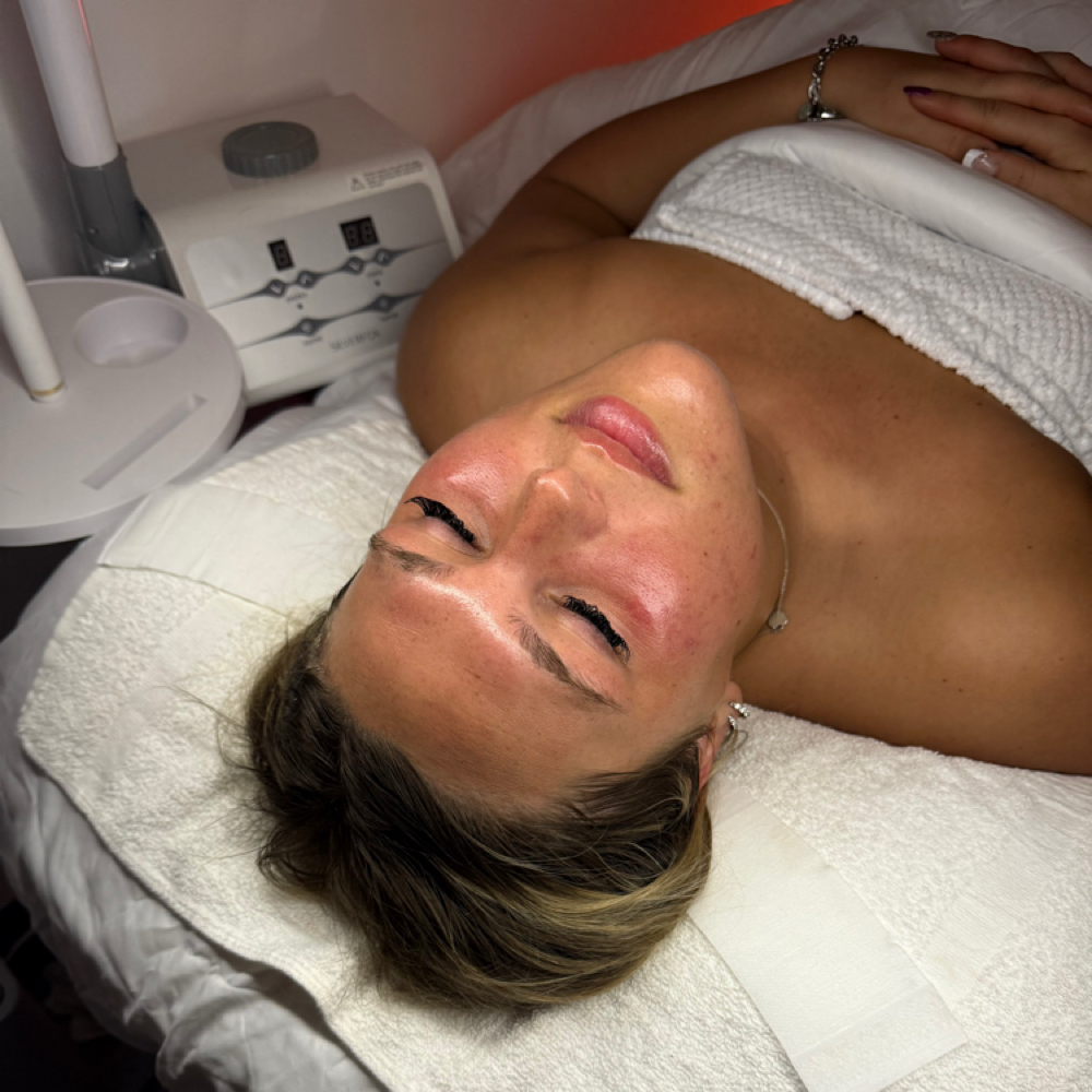 The Glow Peel at The Skin Suite in Batesville, IN