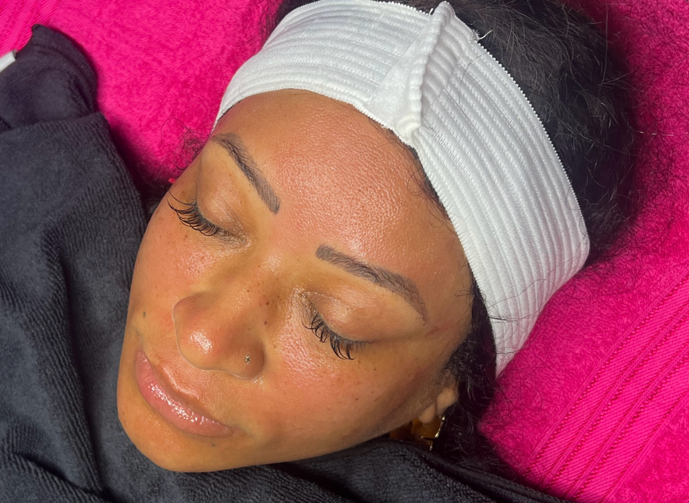 Microneedling Facial