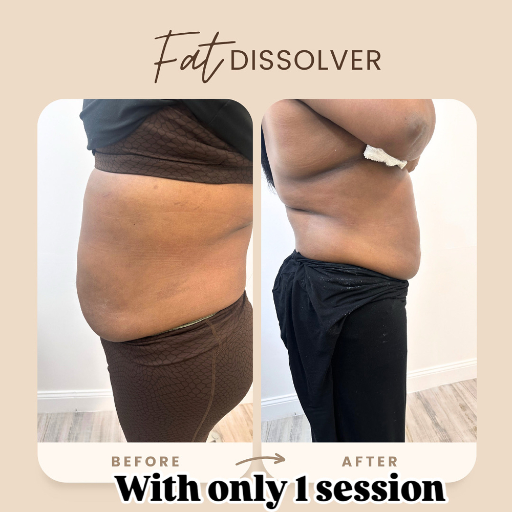 Abdomen Fat Dissolver at Arewa Essential Medspa in Mamaroneck, NY