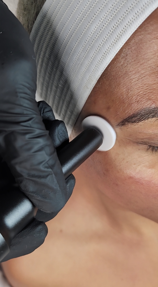 Microchanneling Facial | 3 Sessions