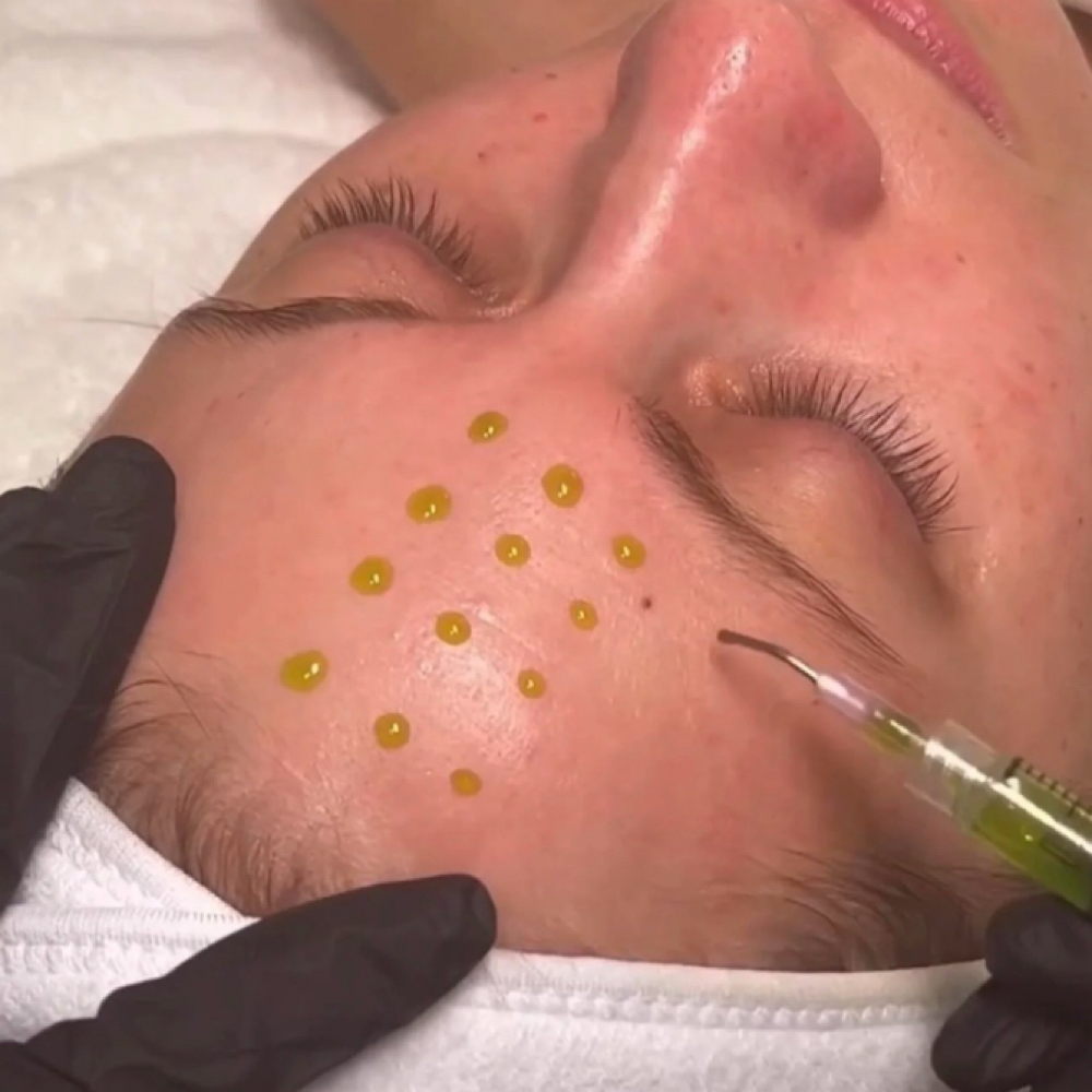 Chemical Peel-Package  (4 Peels) at Bella Lash & Beauty in Cedar Grove, NJ