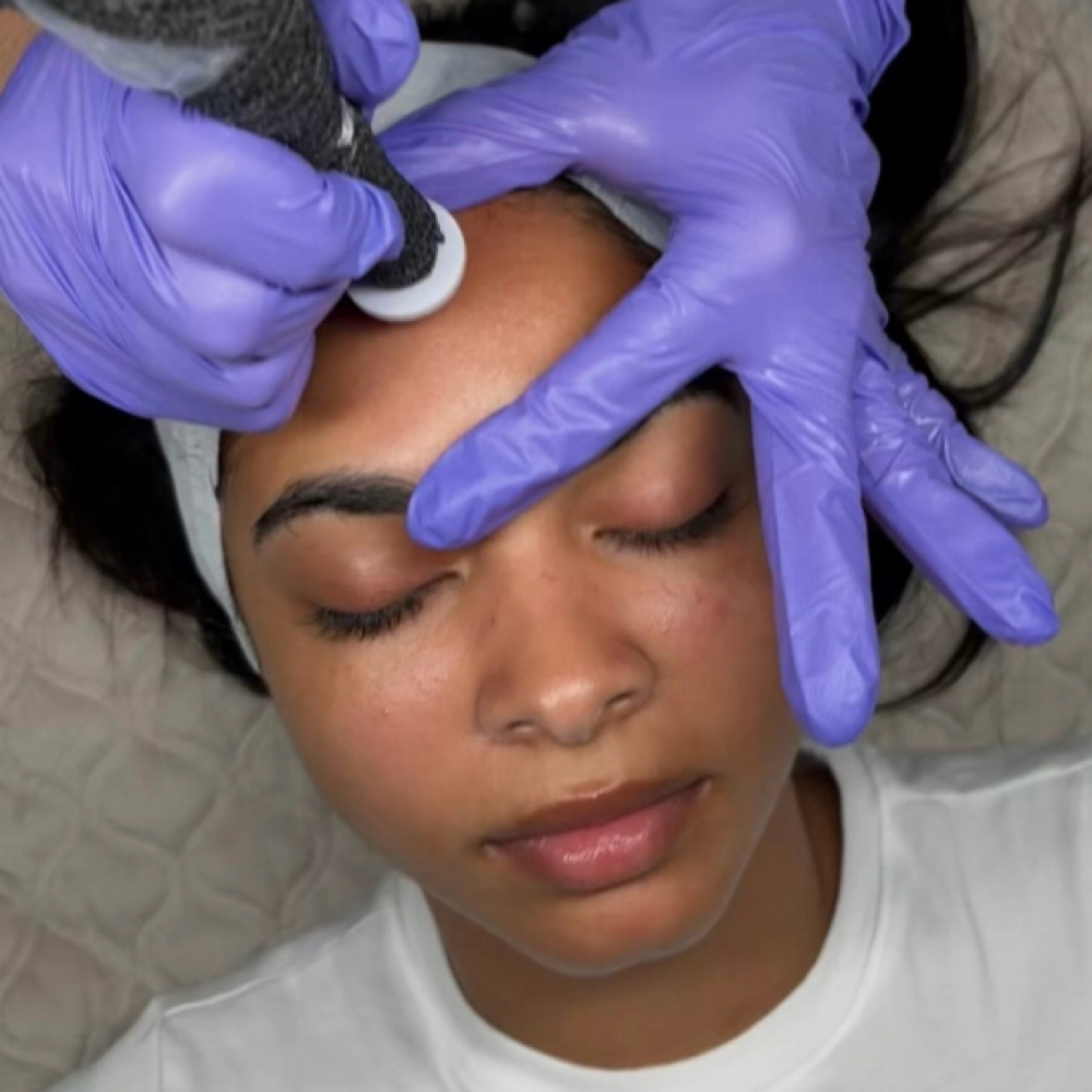 Procell MD Microchanelling at Ocean Waves Aesthetics in Oviedo, FL