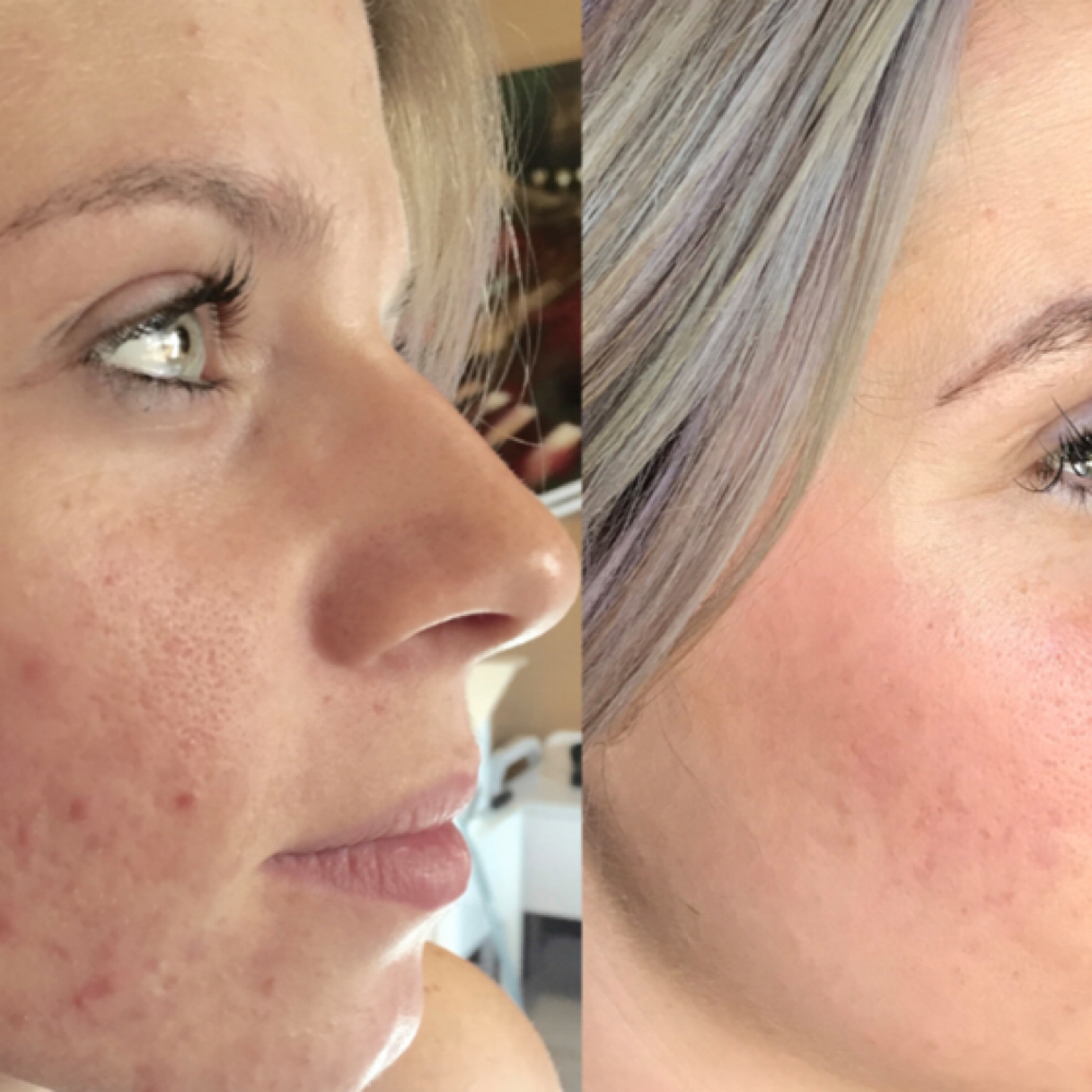 Procell Skin Transformation 4 Packs at Ocean Waves Med Aesthetics in Oviedo, FL