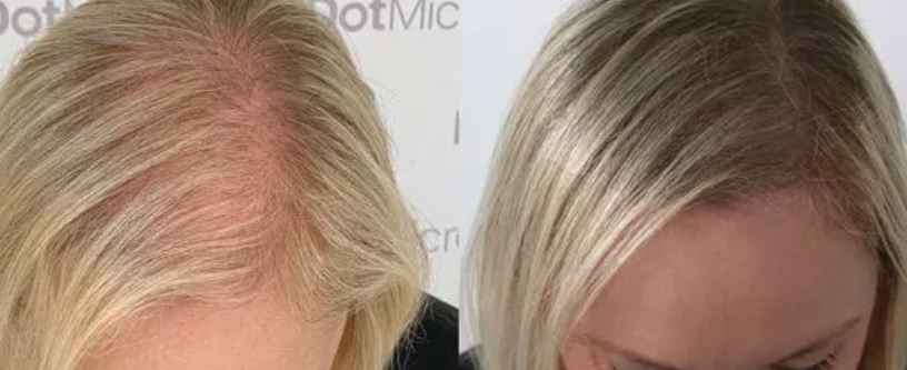 Scalp Micropigmentation (SMP)