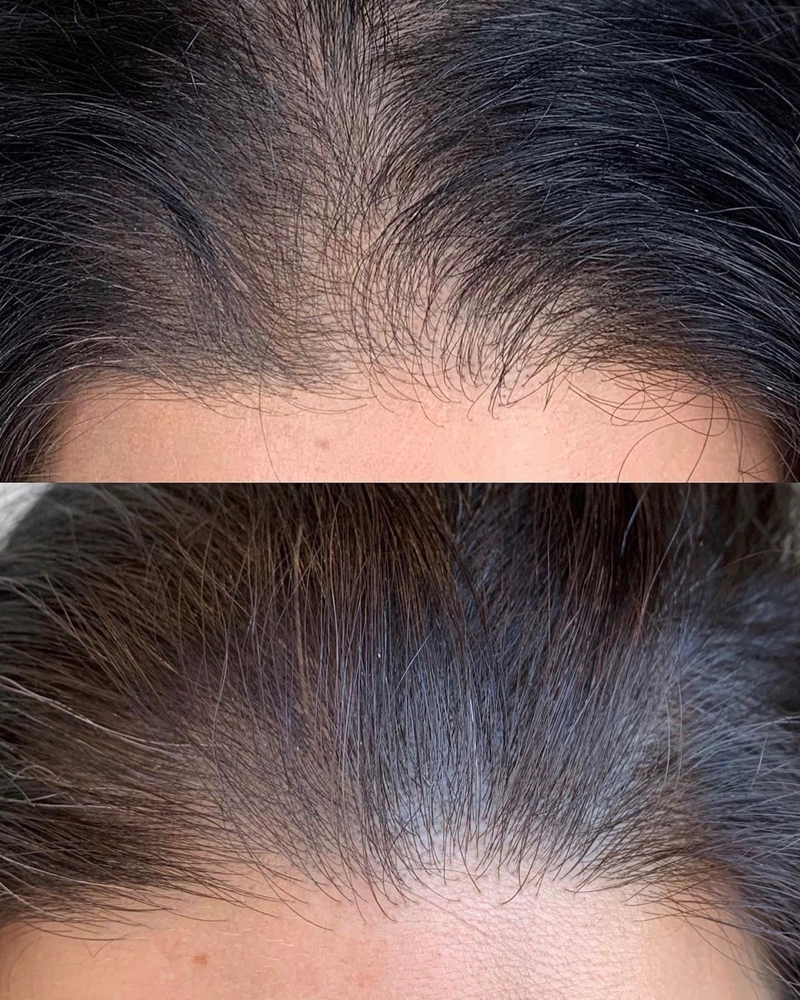 Hairline Micropigmentation